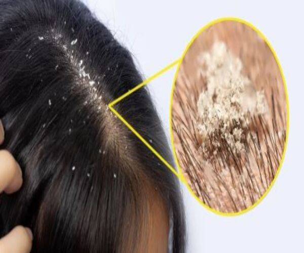 સ્કાલ્પમાં આવે છે ખંજવાળ?