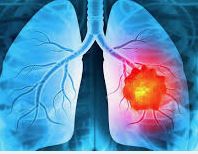 ફેફસાના કેન્સરના આ છે લક્ષણો