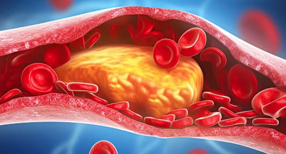 કોલેસ્ટ્રોલ વધવાથી શરીરના આ ભાગમાં થાય છે દુખાવો
