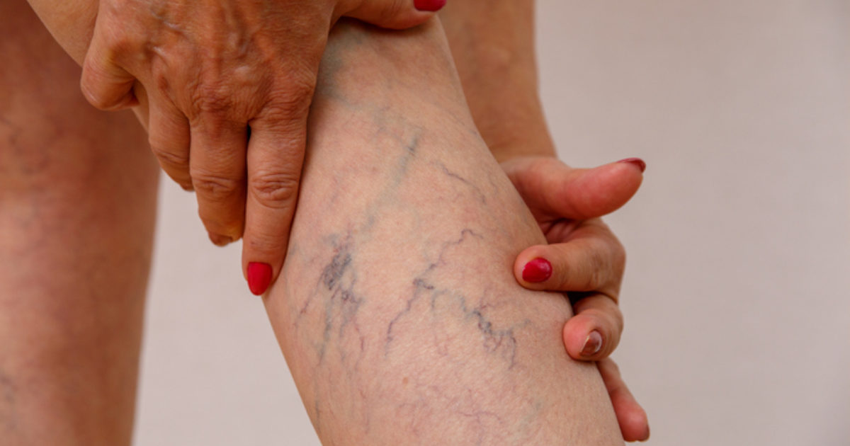 પગની નસો બ્લોક થવા પર દેખાવા લાગે છે આ ગંભીર લક્ષણો