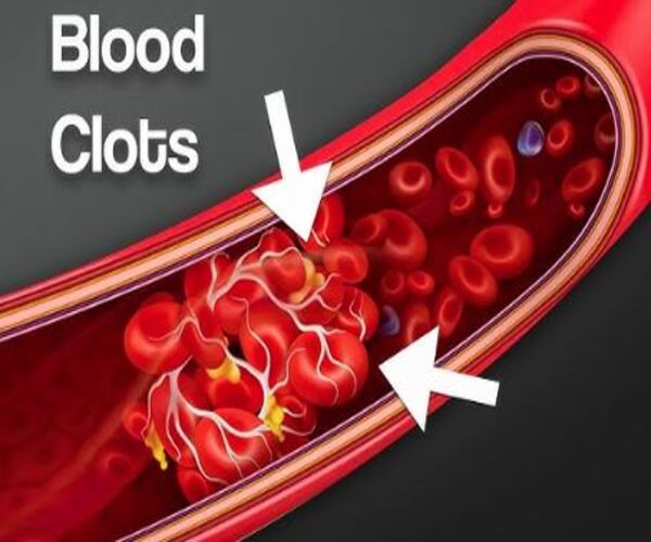આટલા કારણોસર શરીરમાં ગંઠાય છે લોહી