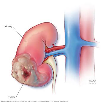 આ લક્ષણો છે કિડનીના કેન્સરના