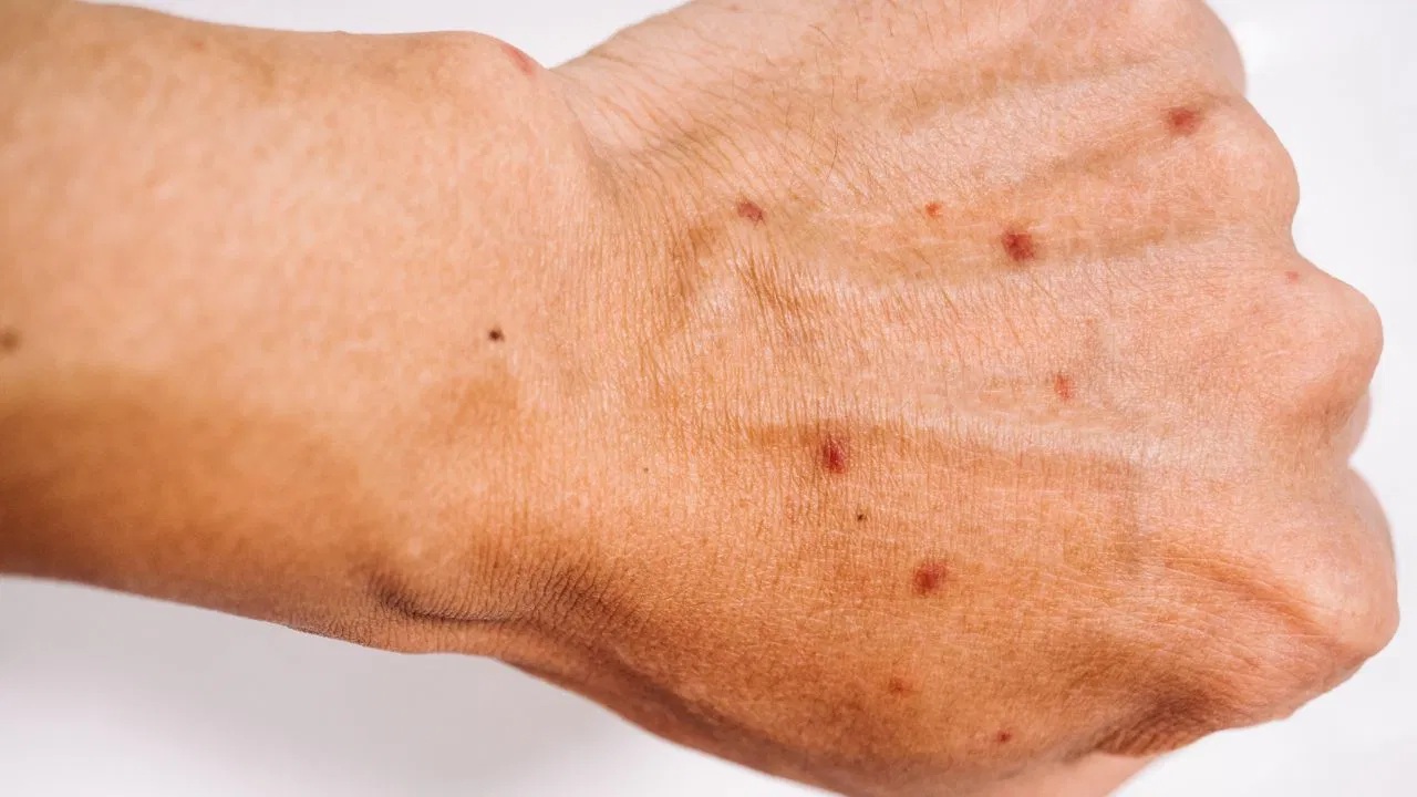 ત્વચા પર ડાયાબિટીસની શું અસર થાય છે?