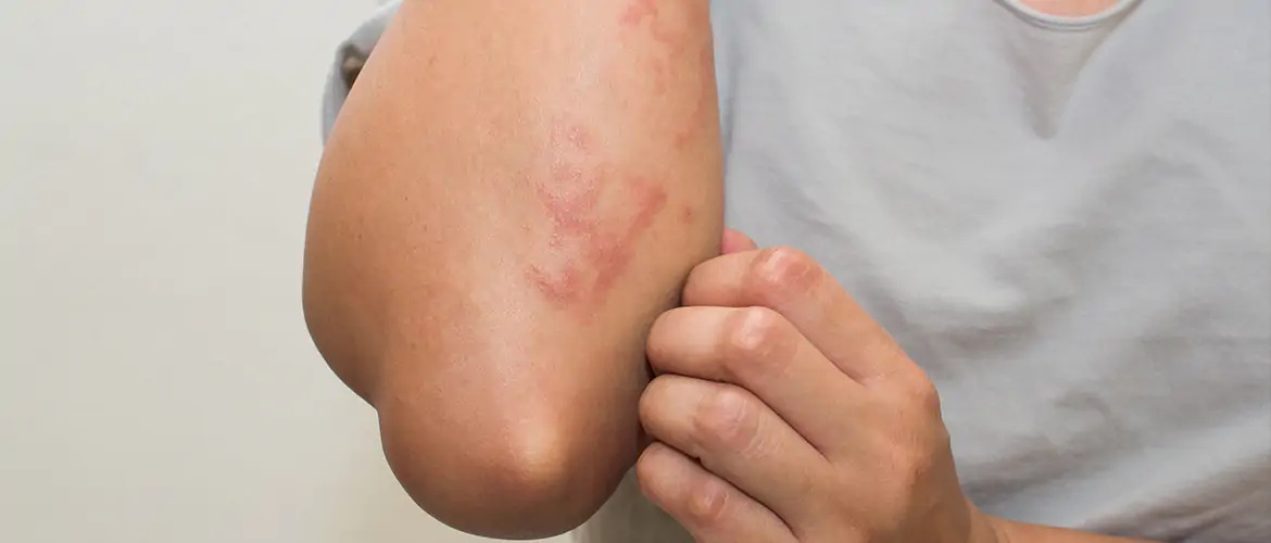 વરસાદમાં ફંગલ ઇન્ફેક્શનથી પરેશાન છો?