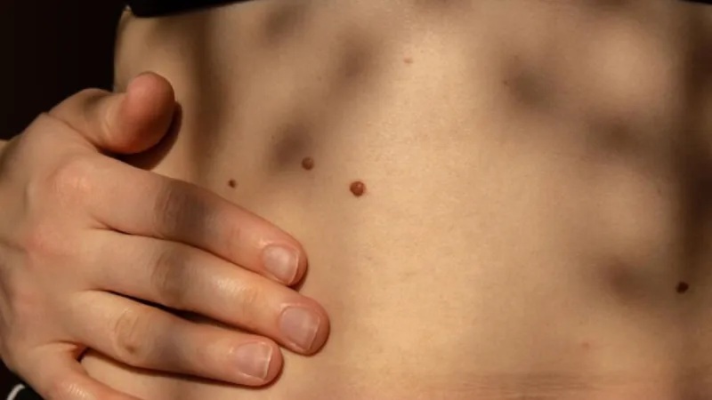 શું તમારા શરીરના આ ભાગ પર તલ છે?