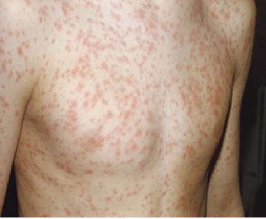 કઈ છે કોરોનાની જેમ ફેલાઈ રહેલી જીવલેણ બિમારીઓ?