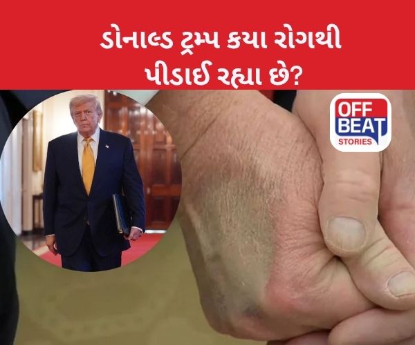 Donald Trump ના પગમાં સોજો, હાથ પર નિશાન