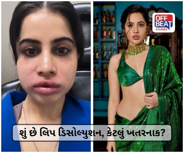 શું છે લિપ ડિસોલ્યુશન, કેટલું ખતરનાક થઈ શકે છે સાબિત?