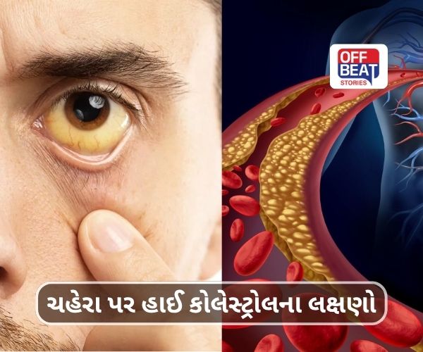 ચહેરા પર દેખાઈ જશે હાઈ કોલેસ્ટ્રોલના લક્ષણો