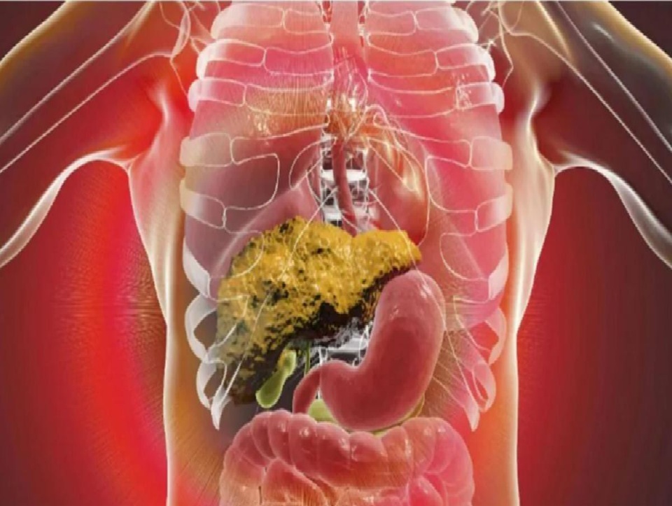 દેશ પર મંડરાઈ રહ્યો છે ફેટી લીવરનો ખતરો