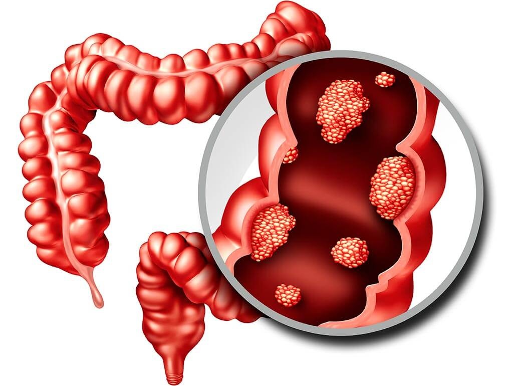 કેન્સરની શરૂઆતમાં શરીરમાં દેખાય છે આ લક્ષણો