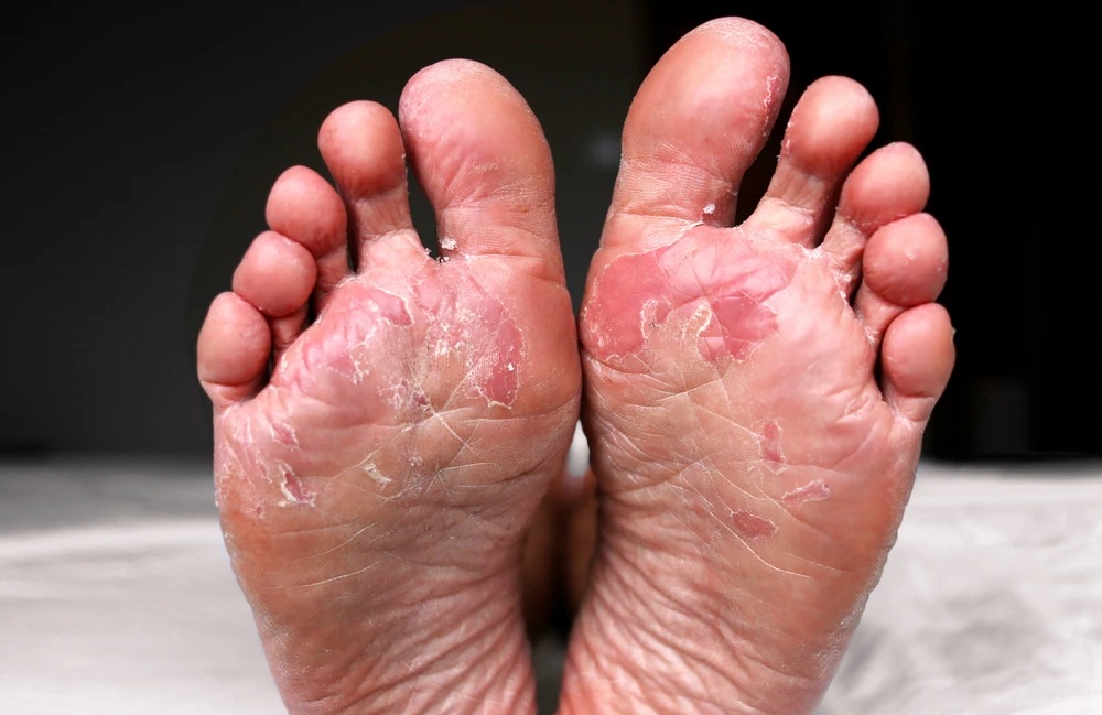 ચોમાસામાં પગમાં થાય છે ફંગલ ઇન્ફેક્શનની સમસ્યા