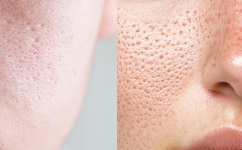 ત્વચા પર દેખાતા ઓપન પોર્સ હટાવા લગાવો આ ફેસ પેક