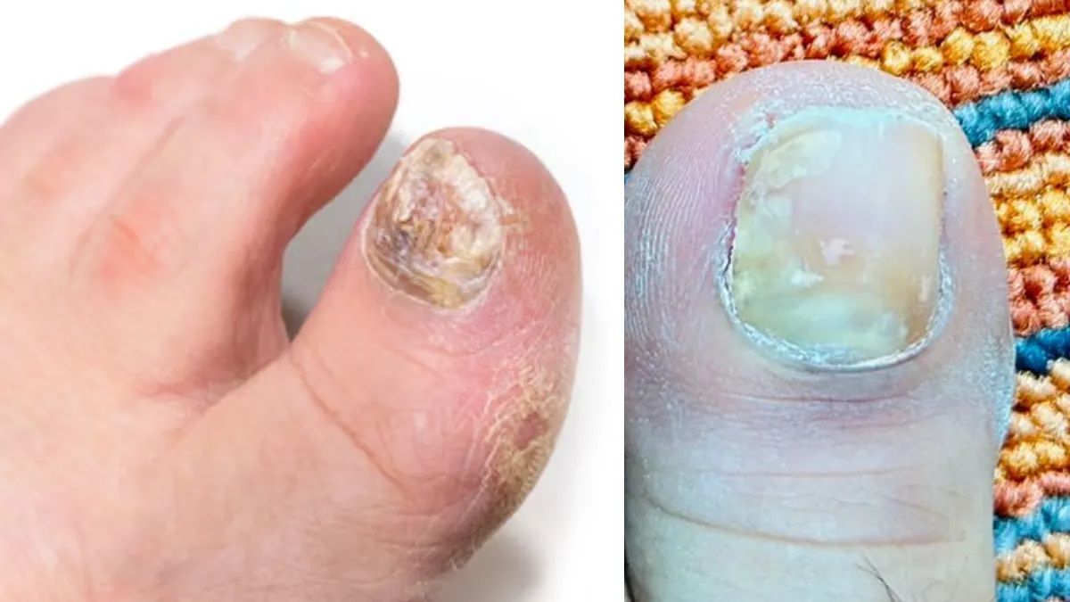 જો તમારા નખ વરસાદમાં સડવા લાગે છે