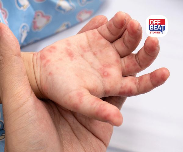 બાળકોથી પુખ્ત વયના લોકોમાં વાયરલ ઇન્ફેકશન