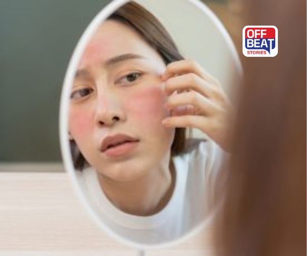 ઈજા વિના પણ દેખાઈ રહ્યાં છે ઉઝરડા