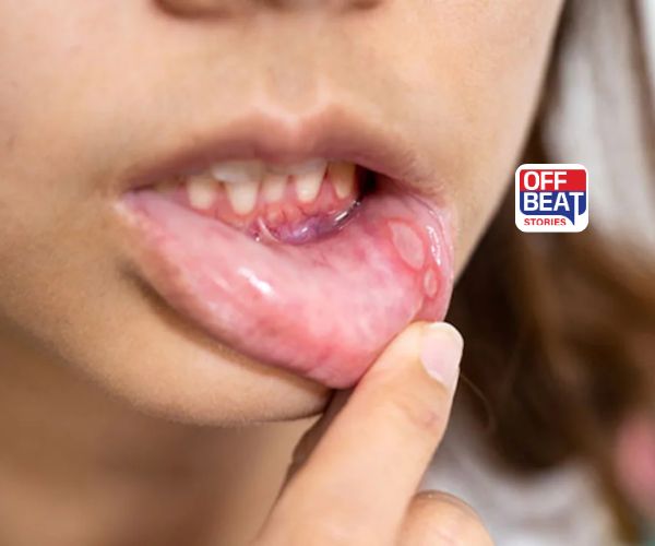 શું તમે મોઢાના ચાંદાથી પરેશાન છો?