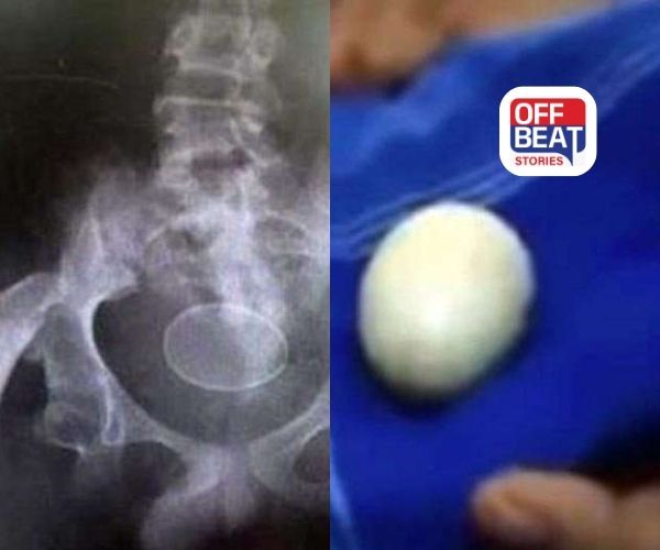 ઇન્ડોનેશિયાનો એક છોકરો બે વર્ષથી ઇંડા આપે છે