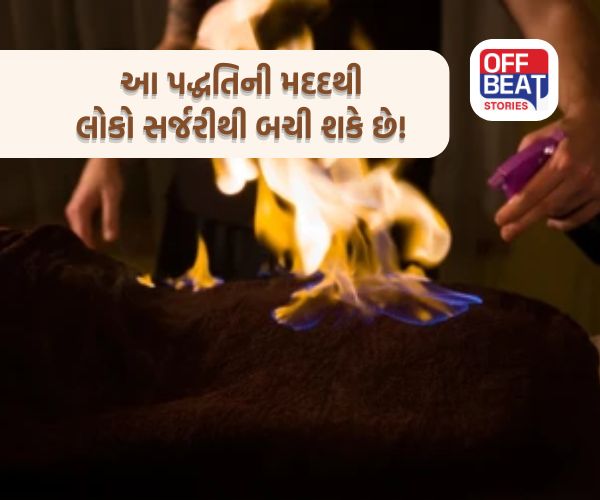 Fire Therapy; અહિયાં શરીર પર આગ લગાવીને કેન્સર જેવા રોગોની સારવાર!: 100 વર્ષોથી વધુ સમયથી આ પદ્ધતિનો ઉપયોગ થાય છે