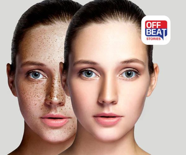 માત્ર 20 રૂપિયામાં ચહેરાના કાળા ડાઘ ગાયબ!: અજમાવો આ અદ્ભુત પેસ્ટ! પરિણામ જોઈને ચોંકી જશો!