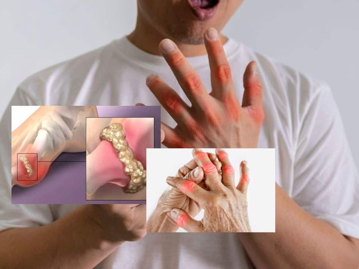 દવા વગર પણ નિયંત્રિત થઈ શકે છે યુરિક એસિડ