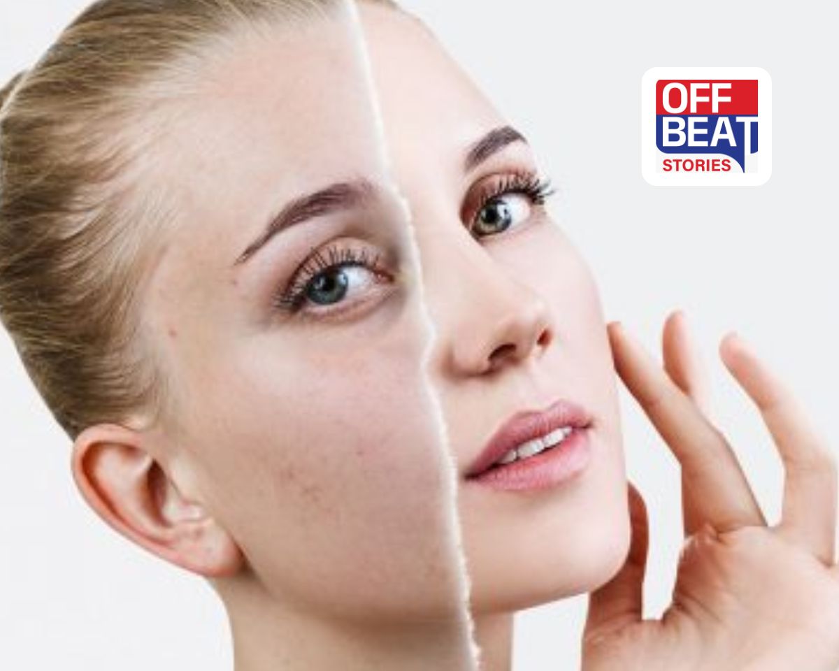 ખીલના ડાઘ અને નિશાનને કાયમ માટે કહો અલવિદા