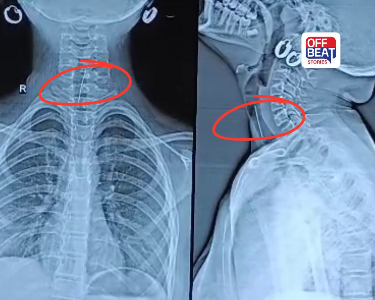 SSG હોસ્પિટલના તબીબોએ કરી કમાલ