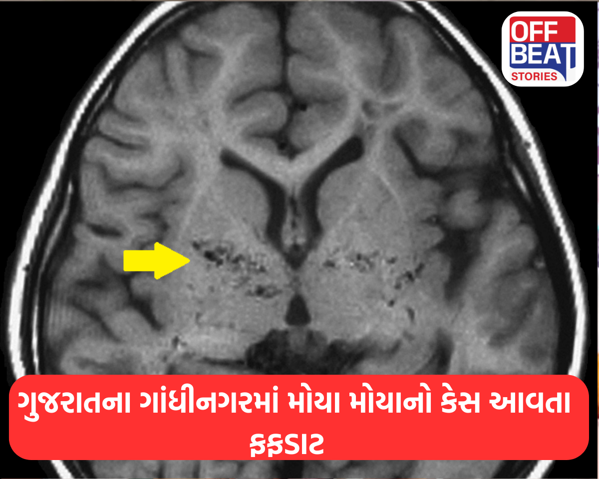 ગુજરાતના ગાંધીનગરમાં મોયા મોયાનો કેસ આવતા ફફડાટ