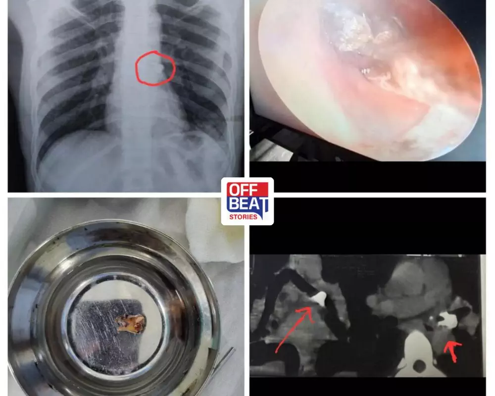 દોઢ વર્ષથી શ્વાસનળીમાં ફસાયેલો હતો દાંત
